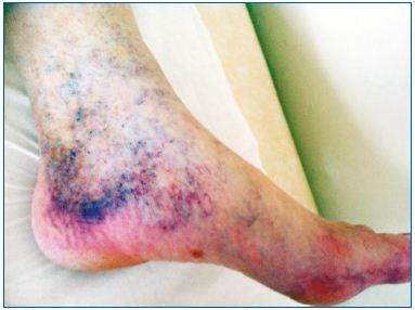 Figure 4. A classic corona phlebectatica Van der Molen has been described as being composed of numerous telangiectasia grouped together at the edges.