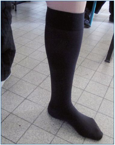 Figure 5. Two layered medical compression stockings. The fabric of the two stockings is identical so that the outer stocking slips easily over the under stocking. In this photo, two knee-high stockings are worn one on top of the other.