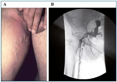 Figure1. PREVAIT clinical aspect. A. Pelvic vein leak. B. Selective pelvic venography from the same patient as A. (Courtesy of Drs Monedero and Zubicoa).