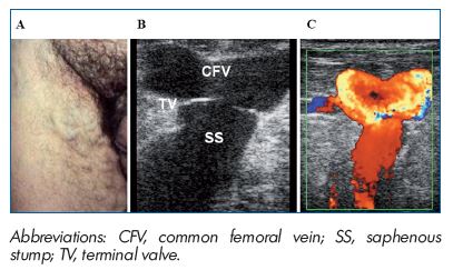 Figure 3. PREVAIT clinical aspect. A. Massive groin recurrence related to non flush high ligation in a patient with an incompetent GSV terminal valve. B. Same patient with a B mode ultrasound. The terminal valve is identified at the saphenofemoral junction. (Courtesy of Dr Gillet). C. Same patient with a color duplex ultrasound. Massive reflux induced by a Valsalva maneuver. (Courtesy of Dr Gillet).