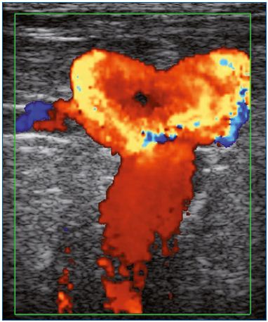 Figure 1. Presence of varices at the groin in a patient previously treated by saphenofemoral ligation. Color duplex ultrasound. Massive reflux induced by a Valsalva maneuver. Image courtesy of Dr Gillet.