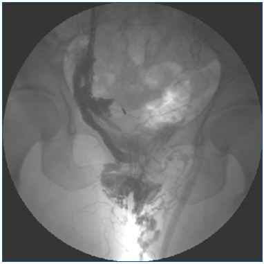 Figure 3. Selective phlebography of the right pudendal vein feeding the left GSV. Abbreviations: GSV, great saphenous vein. Image courtesy of Dr Monedero and Dr Zubicoa.