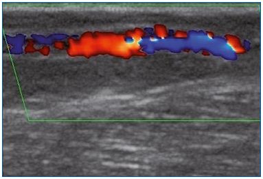 Figure 1A. Longitudinal section of the great saphenous vein at the lower third of the thigh. Segmental reflux on duplex scanning examination in the evening after being in a prolonged upright position.