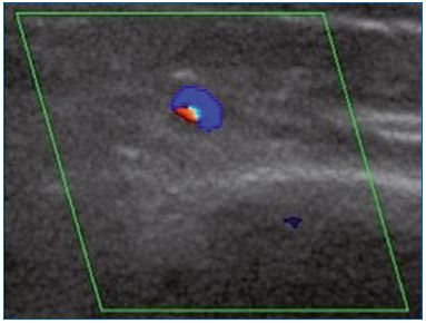 Figure 1B. Cross-section of the great saphenous vein at the lower third of the thigh allowing an assessment of vessel diameter (4.8 mm). Commissural reflux on duplex scanning examination in the evening after being in a prolonged upright position.