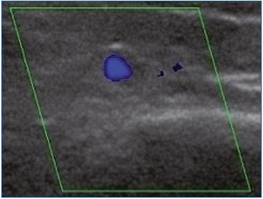 Figure 1C. Cross-section of the great saphenous vein in the valve area at the lower third of the thigh allowing assessment of vessel diameter (4.5 mm). Absence of reflux on duplex scanning examination in the morning after rest.