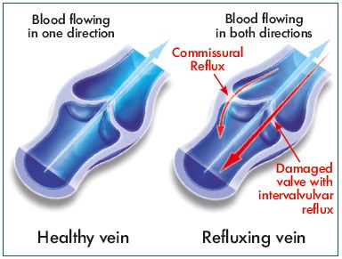 Figure 1D. Illustration of a commissural reflux.