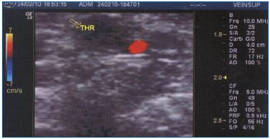Figure 1. Thrombosis in a twin vein 4 hours after a flight.