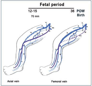 Figure 8. Summary of the fetal period of development (after week 8). The primitive veins are colored in purple. Notice that the fetus (weeks 9 to 15) commonly has a big axial vein while the femoral vein is smaller and plexus shaped. Later, the axial vein becomes a small arcade along the sciatic nerve, and the femoral vein becomes the main trunk of the thigh in the majority of cases at birth, commonly with a collateral canal. Abbreviations: 3, fibular veins; 4, arch of the SSV; 5, great saphenous vein; 7, anterior tibial veins; 8, SSV; 9, posterior tibial; 10, femoral vein; 11, axial vein; 12, epigastric vein; 13, thigh extension of SSV; 14, deep femoral vein; 15, obturator vein; 16, hypogastric vein; 17, external iliac vein; 18, inferior gluteal vein; cc, collateral canal; P, perforating branches of the femoral vein; POW, postovulatory week; sna, axial arcade along the sciatic nerve; SSV, small saphenous vein.