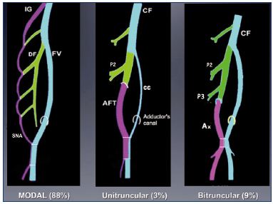 Figure 12. Anatomical variations of the femoral vein occur in 12% of adults. If the primitive “axial vein” of the embryo persists, either an axiofemoral trunk (unitruncular layout, 3%) or an axiofemoral vein (bitruncular layout, 9%) can be found in adults. In the modal layout (88%), the primitive axial vein becomes hypotrophic and, reduced to a small arcade. Abbreviations: AF, axiofemoral vein; AFT, axiofemoral trunk; cc, collateral canal; CF, common femoral vein; DV, deep femoral vein; FV, femoral vein; IG, inferior gluteal vein; P2, second perforator vein; P3, third perforator vein; SNA, sciatic nerve arcade.