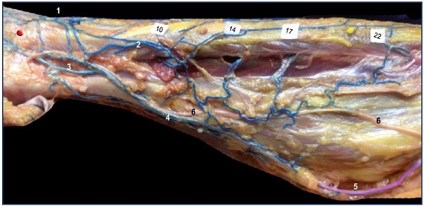 Figure 13. Remnant of marginal vein and fibular perforators in an adult. Anatomical dissection after latex injection in the left leg (lateral view after resection of the fibula bone). Notice the alignment of the fibular perforator veins connecting the thin marginal network to the fibular veins at specified locations (10, 14, 17, and 22 cm from the apex of the lateral malleolus). Abbreviations: 1, dorsal foot network connected to the anterior tibial perforators; 2, lateral marginal network connected to the fibular veins; 3, calcaneus perforator vein; 4, Achilean vein joining the small saphenous vein.