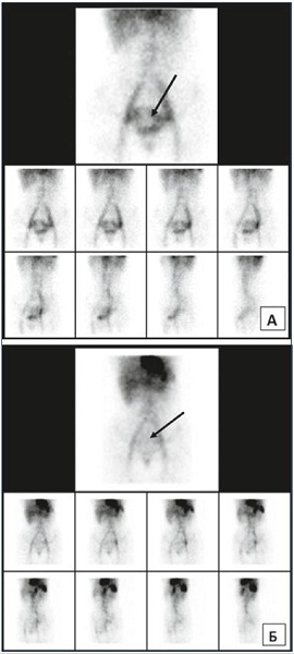Figure 2. ECT assessment of pelvic veins before and after MPFF treatment. ECT of the pelvic veins at baseline (Panel A) and after an 8-week MPFF treatment (Panel B) in a patient with pelvic vein dilation in isolated PVV. Deposit of labeled erythrocytes in the uterine venous plexus is indicated by the arrows. Abbreviations: ECT, emission computer tomography; MPFF, micronized purified flavonoid fraction; PVV, pelvic varicose veins.