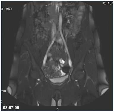 Figure 2. May-Thurner syndrome. Illustration of the translucency and widened left common iliac vein due to the compression from the right common iliac artery using magnetic resonance venography. From reference 25: Bækgaard et al. Phlebology. 2014;29(suppl 1):118-118. © 2014, SAGE Publications.