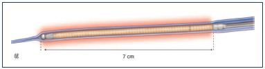 Figure 1.* ClosureFAST catheter. The first 7 cm (left) of the coated heating element and the thermocouple (right).