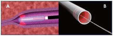 Figure 3. Fiber with radial emission. Fiber with single radial emission (Panel A) and double radial emission (Panel B).