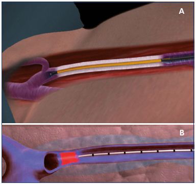 Figure 4. Positioning of the ClosureFAST catheter (A) and the laser fiber (B). Panel A. The ClosureFAST catheter is positioned 2 cm below the saphenofemoral junction at the beginning of the procedure before generator activation. Panel B. The laser fiber catheter is positioned 2 cm below the saphenofemoral junction at the beginning of the procedure before activation. The veins are colored blue.