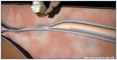 Figure 6. Compression of the treated vein using an ultrasound transducer above the catheter and injected glue.