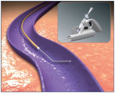 Figure 7. The vein lumen was catheterized using the ClariVein rotating wire.