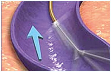 Figure 8. The ClariVein rotating wire abrades the vein wall, while the sclerosing agent is infused through the catheter opening.