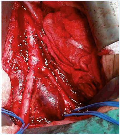 Figure 3. Iliac vein compression seen from the outside. From reference 25: Bækgaard et al. Phlebology. 2014;29(suppl 1):118-118. © 2014, SAGE Publications.