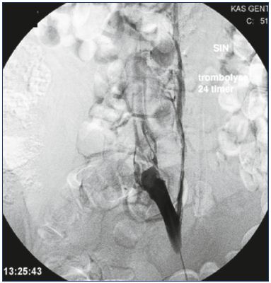Figure 4. Persistent obstruction after CDT. All thrombus material has been removed, but the obstruction has to be stented. Abbreviations: CDT, catheter-directed thrombolysis