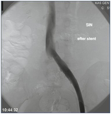 Figure 5. A successfully placed stent.