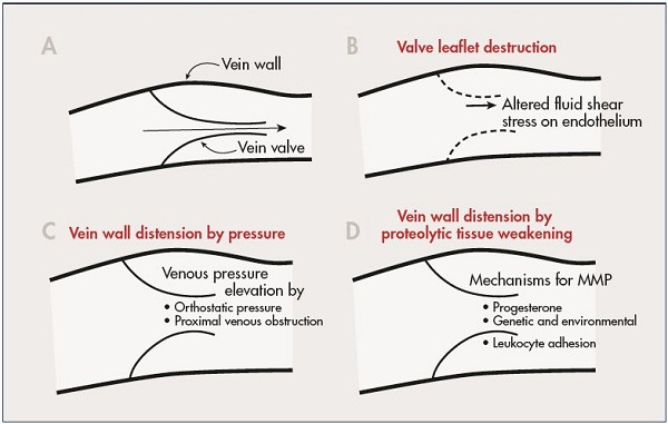Figure 2. A schematic diagram illustrating selected mechanisms that may control inflammation of the vein wall and valve leaflet. A normal vein valve and wall is shown in Panel A. Valve leaflets may be subject to inflammatory damage by alteration in magnitude and direction of fluid shear stress on the endothelium (Panal B). Venous valves may become unable to close their leaflets due to vein wall distension by elevated venous pressure (Panel C), or by weakening of the vein wall due to proteolytic degradation of its extracellular matrix (Panel D). Abbreviation: MMP, matrix metalloproteinases From reference 11: Schmid-Schönbein. Medicographia. 2008;30:121-126. Image courtesy of the author.