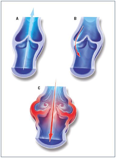Figure 4. Illustrations of venous valves with and without reflux. Illustrations of a normal venous valve without reflux (Panel A), a valve with a nonpathological commissural reflux usually seen in the evening after being in a prolonged upright position (Panel B), and a valve with a pathological intervalvular reflux (Panel C). Modified from reference 24: Tsoukanov et al. Phlebolymphology. 2015;22:18-24. Image courtesy of the author.