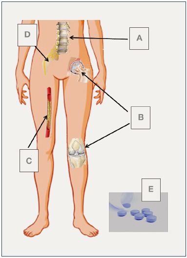 Figure 1. The most common nonvenous causes of the so-called “venous” symptoms. A, Spinal disc herniation; B, hip and knee arthrosis; C, peripheral arterial disease; D, peripheral neuropathy; E, drug adverse reactions (calcium channel blocker or other medications).