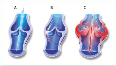 Figure 5. Illustrations of venous valves with and without reflux. Illustrations of a normal venous valve without reflux (Panel A), a valve with a nonpathological commissural reflux usually seen in the evening after being in a prolonged upright position (Panel B), and a valve with a pathological intervalvular reflux (Panel C). From reference 24: Tsoukanov Y et al. Phlebolymphology. 2015;22:18-24. Image courtesy of the author.