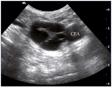Figure 2. Intraluminal webs in the common femoral vein (transverse view). Abbreviations: CFA, common femoral artery.