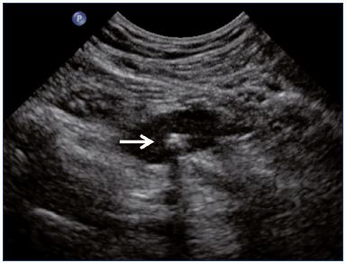 Figure 3. Phlebolith showing the transverse view of the soleal vein in the calf.