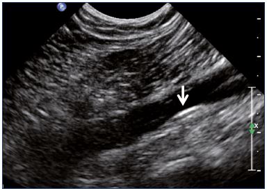 Figure 5. Popliteal vein with wall thickening (longitudinal view).