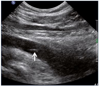 Figure 6. Popliteal vein with valve thickening (longitudinal view).