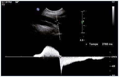 Figure 7. Popliteal vein with significant reflux (longitudinal view).