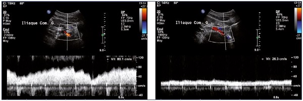 Figure 8. Increase in venous flux velocities at the termination of the left iliac vein (Panel A) compared with velocities measured distally to the stenosis (Panel B) (spontaneous flow).