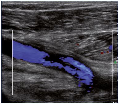Figure 9. Color Doppler ultrasound of the popliteal vein (longitudinal view). There is a partial recanalization with irregular colorization of the lumen vein.