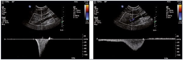 Figure 10. Left and right popliteal vein (longitudinal view). Normal (Panel A) and pathological (Panel B) velocity profiles during an augmentation maneuver.