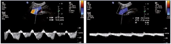 Figure 11. Left and right common femoral vein flux. Right common femoral vein flux with a patent and healthy right iliac vein (Panel A) and left common femoral vein flux with left iliac vein obstruction (Panel B).