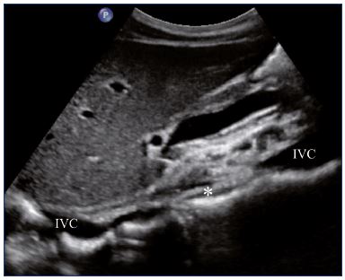 Figure 12. Inferior vena cava atresia* (longitudinal view). Abbreviations: IVC, inferior vena cava.