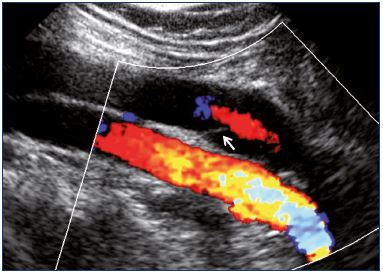 Figure 14. Popliteal vein as obtained from color Doppler ultrasound showing central reflux through a nonthickened valve (longitudinal view).