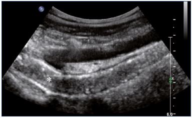 Figure 15. Thrombosis* of the left iliac vein 1 day poststenting (longitudinal view).