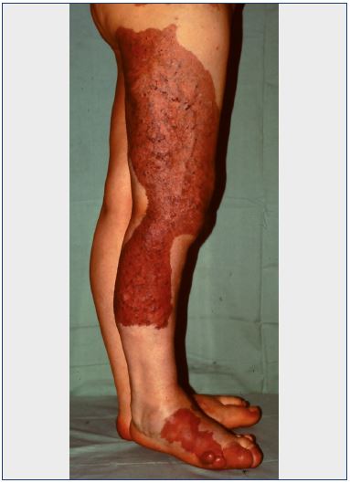 Figure 1. Diffuse cutaneous nevus in a case of Klippel-Trenaunay syndrome.