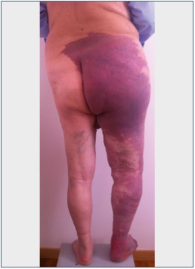 Figure 2. A case where the triad of signs for Klippel-Trenaunay syndrome is present–nevus, limb overgrowth, and dilated superficial veins.