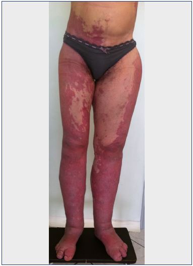 Figure 3. Bilateral Klippel-Trenaunay syndrome of the lower limbs.