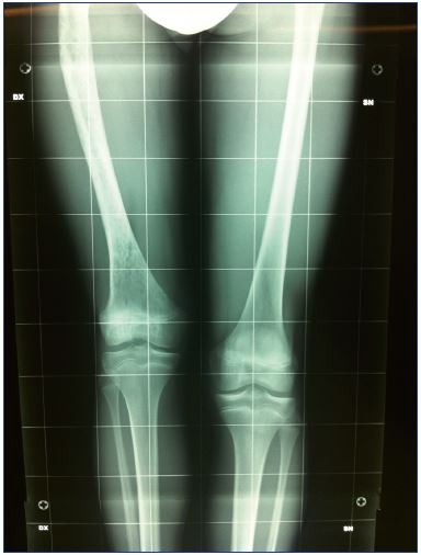 Figure 5. X-ray examination showing a limb–length discrepancy.