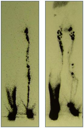 Figure 9. Lymphoscintigraphy of the deep and superficial lymphatic drainage system. Panel A shows an absence of draining lymphatic vessels (right) and dermal backflow in the deep system. Panel B shows a slow drainage in the superficial system (right).
