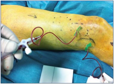 Figure 11. Alcohol is injected directly into the malformation and outflow is controlled using a contrast injection, which is administered before the alcohol.