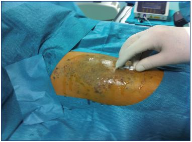 Figure 12. Interstitial laser treatment.