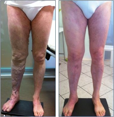 Figure 13. Results of surgical and alcohol treatment for Klippel- renaunay syndrome. Diagnosis demonstrates abnormal, diffuse, superficial veins; hypoplasia of the superficial femoral vein; and deep lymphatic dysplasia. Panel A. Before treatment. Panel B. After treatment.