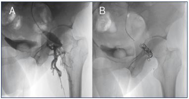 Figure 3. Pelvic leaking point to lower limbs through the gluteal vein. An insufficiency in the internal iliac axis could leak to lower limbs through the gluteal-ischial axis as is observed in this patient. Panel A. The catheter should be placed as distal as possible in the left internal iliac vein, and when using the Valsalva maneuver, the contrast flows through the left gluteal vein to the left limb through a repermeabilized postaxial axis. Panel B. After embolization with coils, no contrast is observed in the gluteal axis because the insufficiency has been corrected.